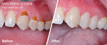 trước và sau trám răng composite 3