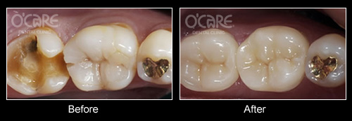 trước và sau khi bọc răng sư cho răng hàm