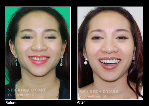 trước và sau khi bọc răng sứ 1