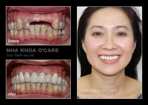 trước và sau khi bọc răng sứ