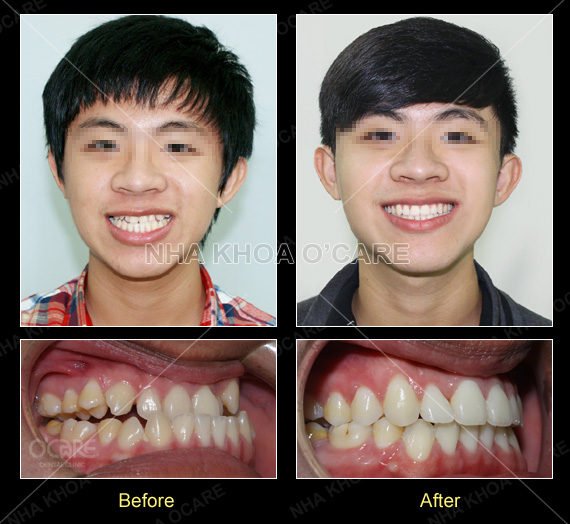 trước và sau niềng răng móm- cắn ngược