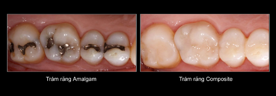 trám răng amalgam và composite