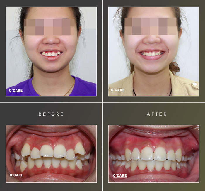 Điều trị răng lòi sỉ (răng khểnh) bằng niềng răng mắc cài sứ
