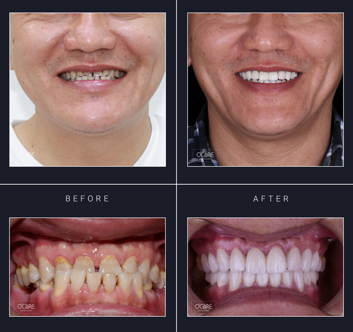 trước và sau khi dán răng sứ veneers 3