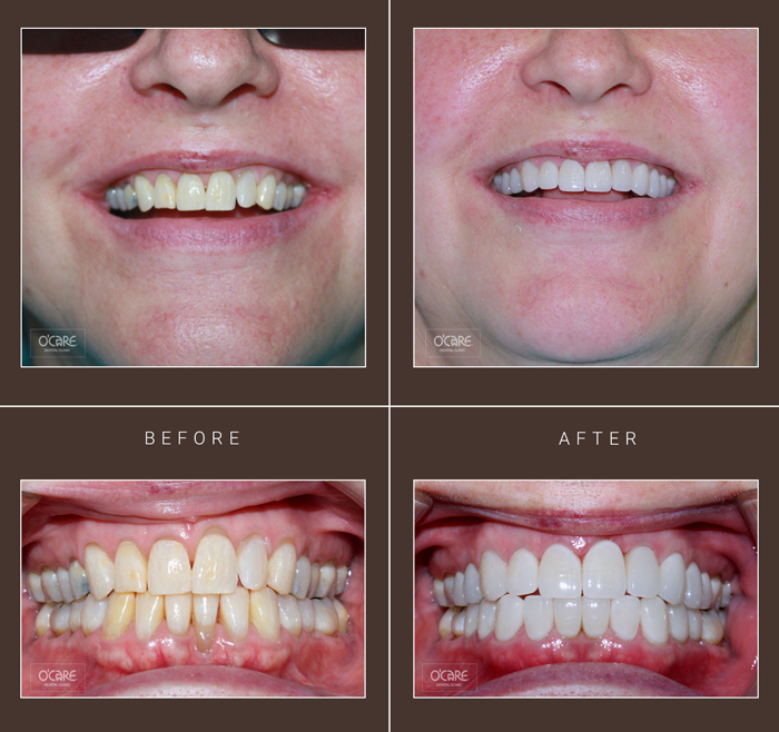 trước và sau khi dán răng sứ veneers