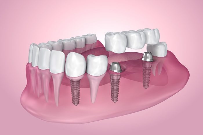 cấy ghép implant làm cầu răng sứ